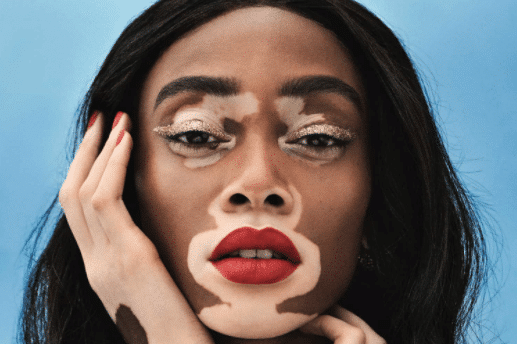 Winnie Harlow (@winnieharlow) - top instagram models